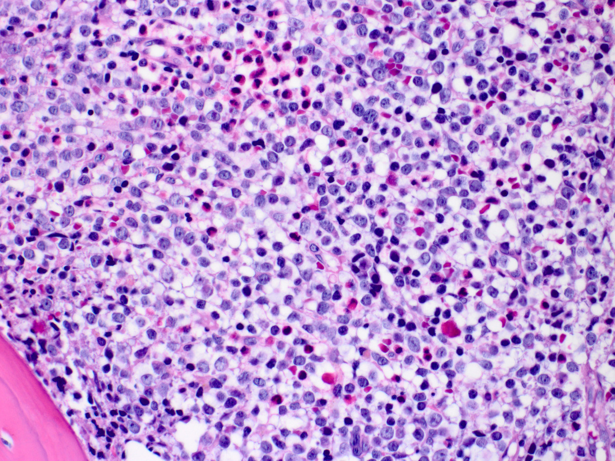BM biopsy sections showing area composed of diffuse extensive infiltrate of blasts and eosinophils (x400, H&E)